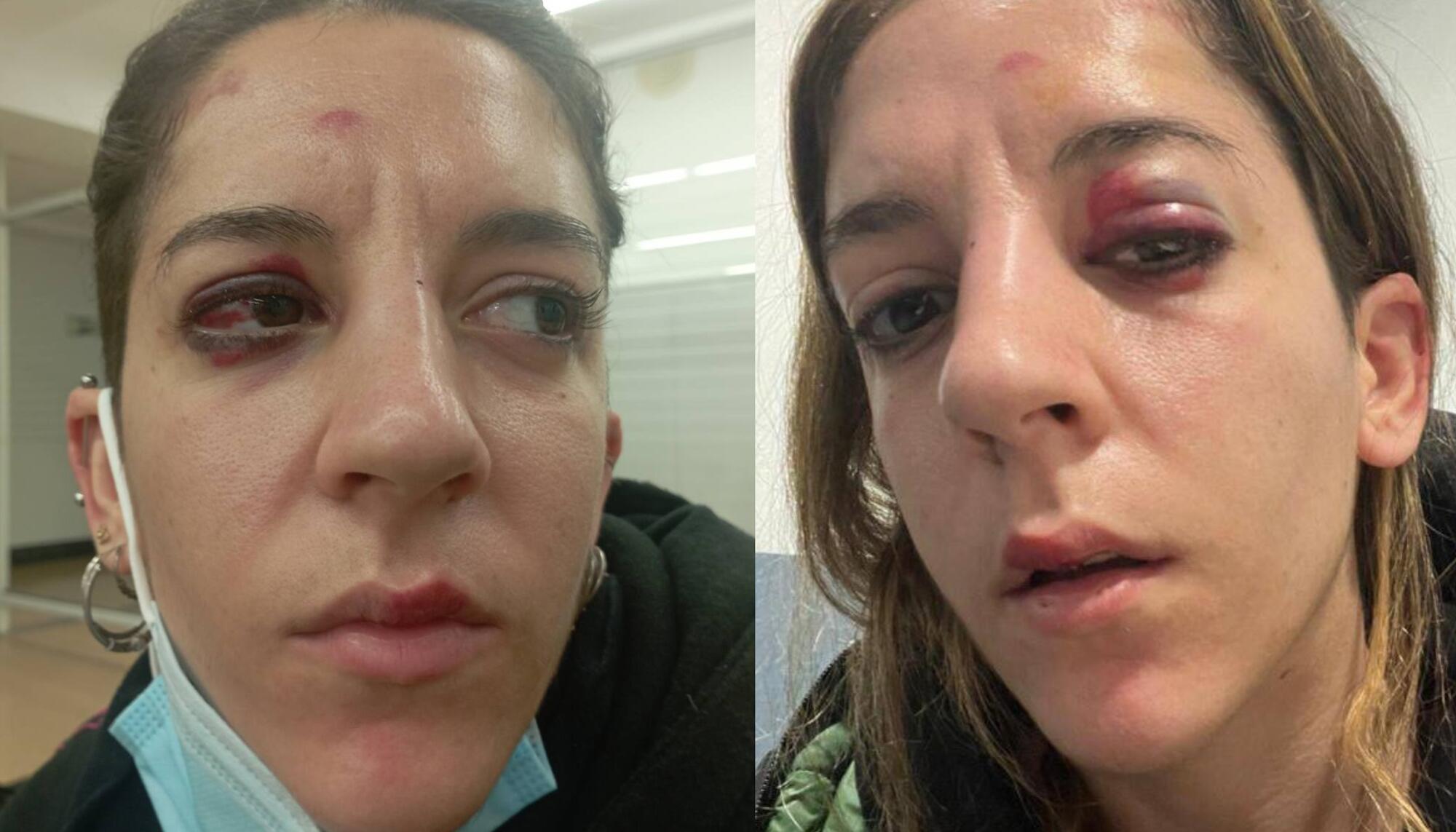 Joana Sales, militante del Sindicato de Vivienda del Raval, tras recibir una paliza durante una detención llevada a cabo por los Mossos d’Esquadra / Cedida 