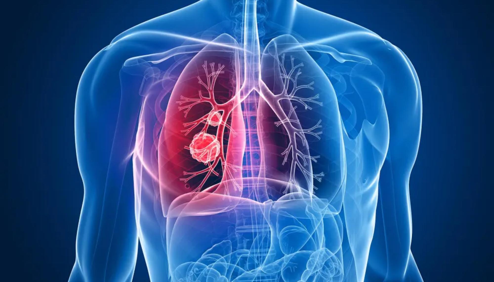cancer pulmon yale