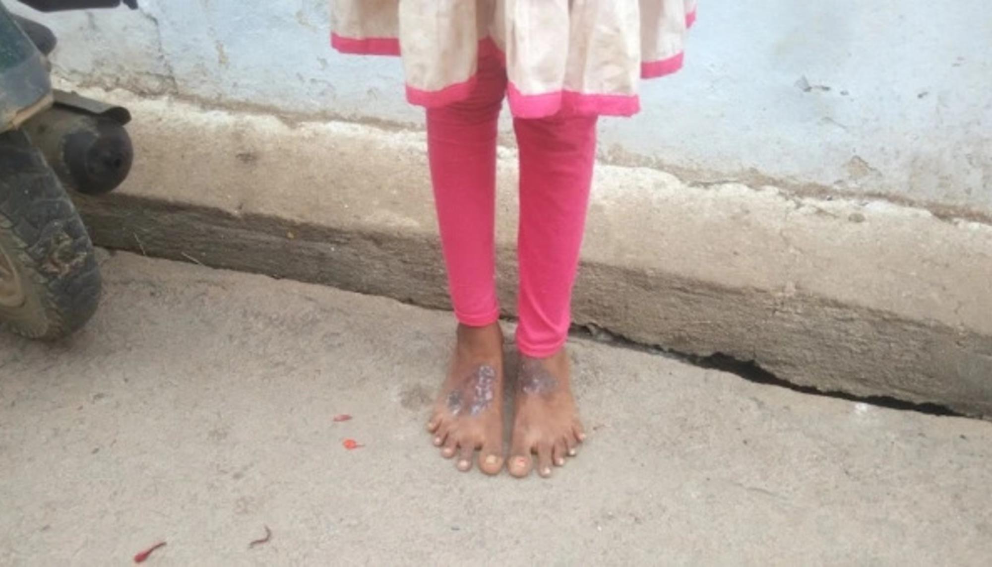 Gangotri tenía 10 años cuando aparecieron las primeras heridas en una pierna. Dos años después, tenía ambas cubiertas de ampollas costrosas que siguen creciendo. 
